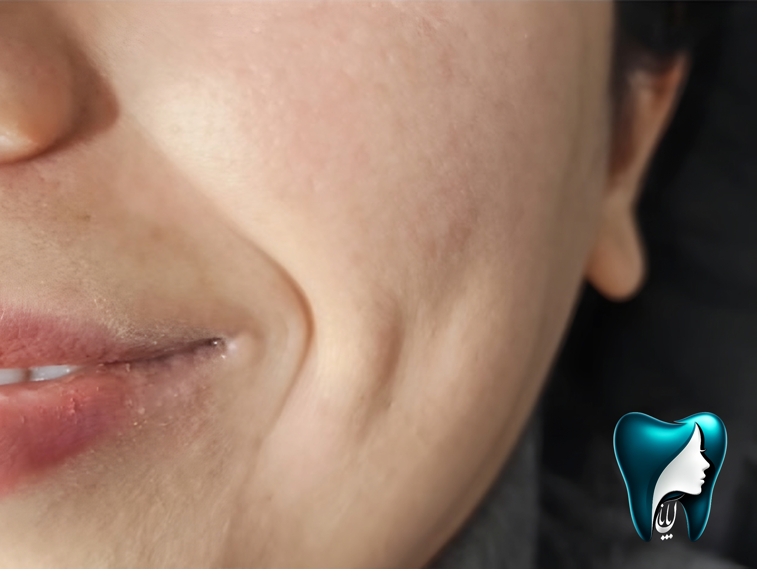 عکس تزریق بوتاکس