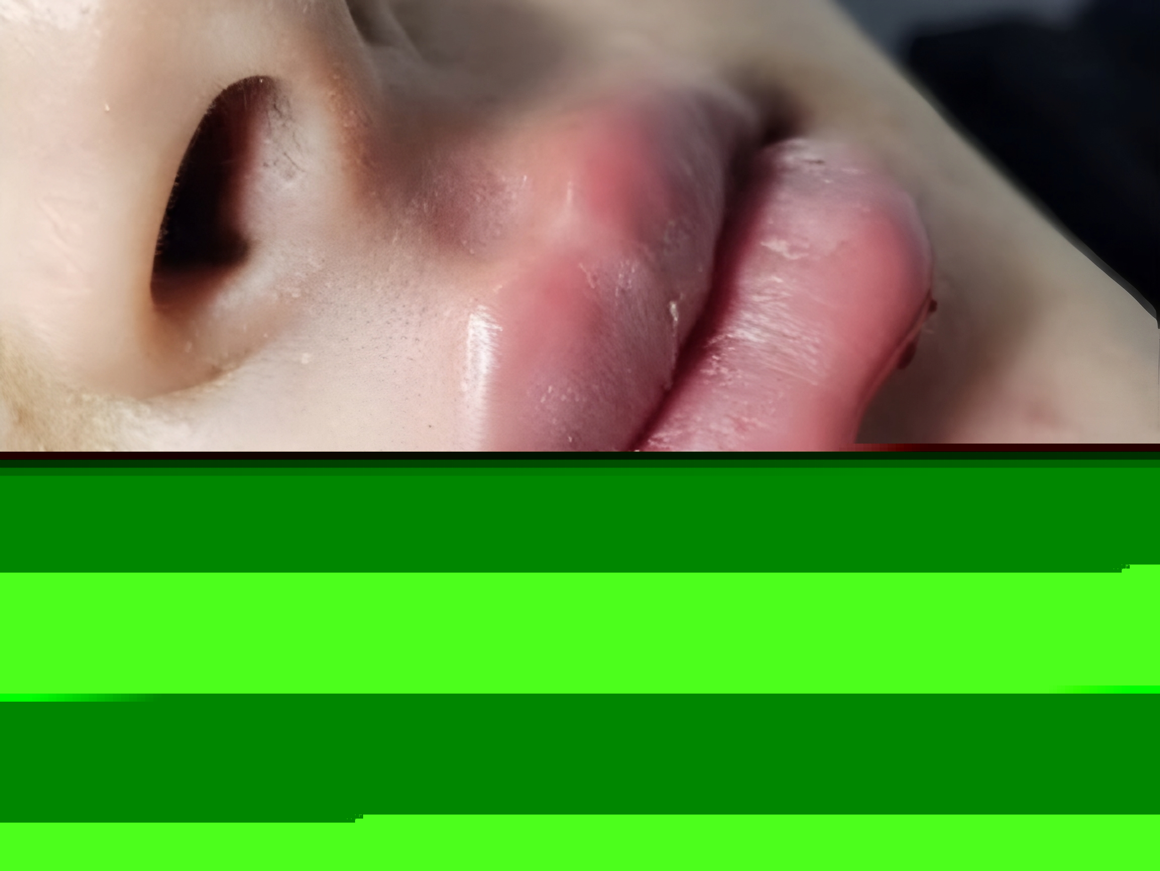 عکس فیلر و ژل