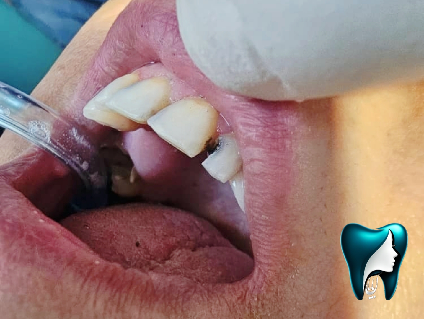 عکس سفید کردن دندان